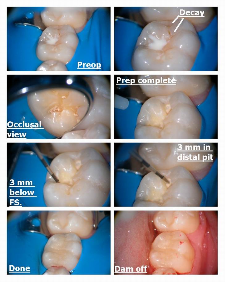 Resize of Failing FS microdental prep.jpg